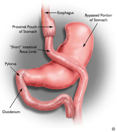 Laparoscopic Roux-en-Y Gastric Bypass